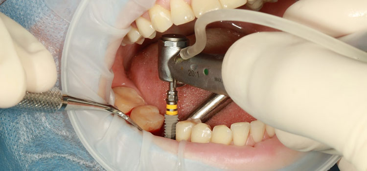 Cosmetic Dental Implants in Casper, WY