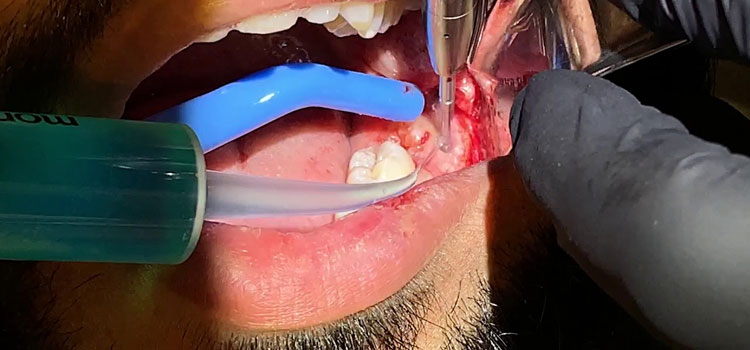 Emergency Tooth Extraction in Ponce, PR